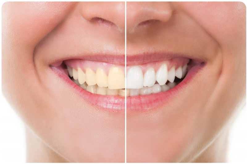 Best cosmetic dentistry treatment in pune